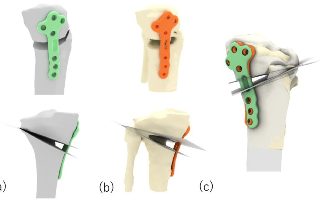 Evaluating the surgical accuracy TOKA patient-specific High Tibial Osteotomy using The IDEAL Framework