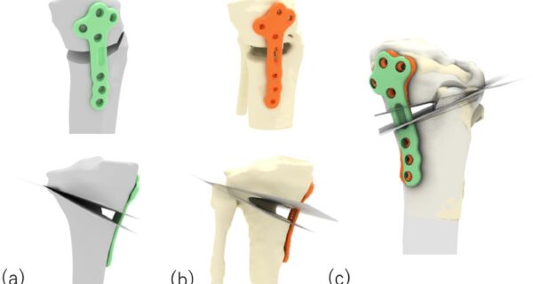Evaluating the surgical accuracy TOKA patient-specific High Tibial Osteotomy using The IDEAL Framework