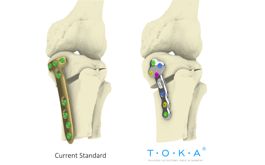 TOKA clinical trial at the Rizzoli Orthopaedic Institute – IOR, Bologna – Italy