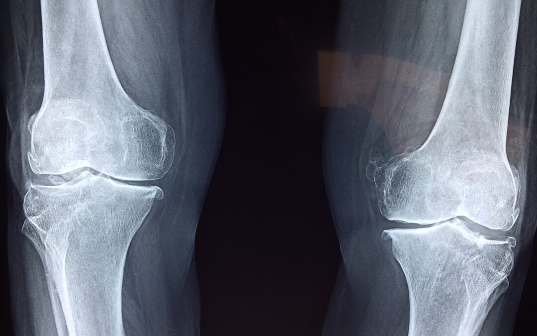 TOKA® Surgical HTO Treatment for Knee Osteoarthritis