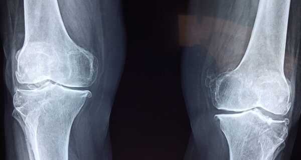 TOKA® Surgical HTO Treatment for Knee Osteoarthritis